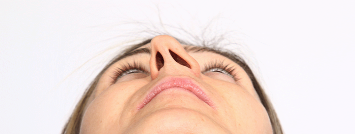 Septum-deviation