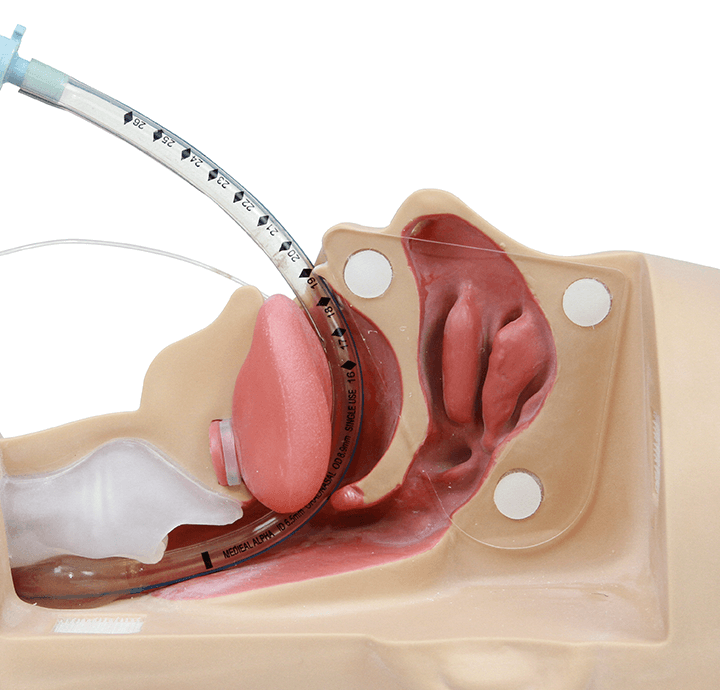ventilation-tube-insertion-selcuk-inanli1